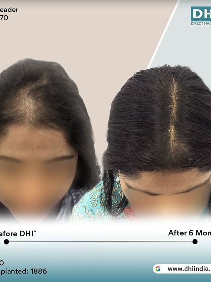 A top-down view of the same female client's 6-month progress. This angle clearly shows the increased density and coverage along her part, demonstrating the effectiveness of our specialized female hair restoration.