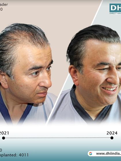 Another side-profile view of the 3-year result. The client's happy expression and full head of hair speak volumes about the success and satisfaction delivered by his DHI procedure.