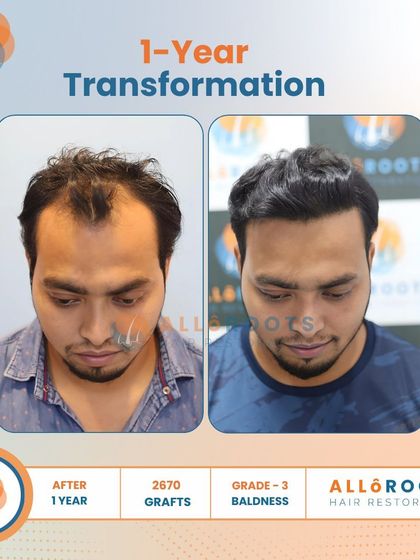 After one year, this patient's Grade 3 baldness was fully addressed with 2670 grafts. The transformation is evident in his smile and the natural, dense hairline that frames his face.
