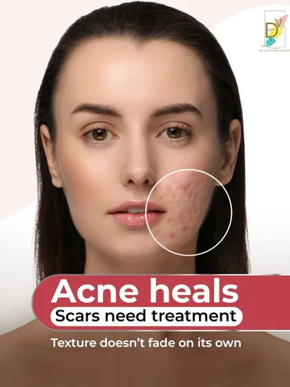 Many people believe acne marks will fade on their own, but this is a myth. While a pimple heals, the scar it leaves behind is a permanent change in skin texture that requires professional treatment. My approach is to assess the scar depth and your skin's healing capacity to create a strategy for real, lasting smoothness.