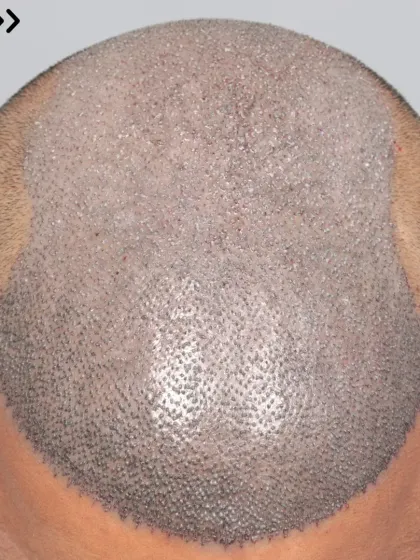 A powerful start for a Norwood Grade 6 case. 6000 grafts were used in a single session for full top coverage.