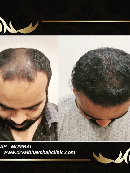 A great top-down comparison showing the successful filling of the vertex area. The patient can now style his hair without worrying about the bald spot showing.