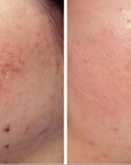 This before-and-after comparison shows the journey from inflamed, textured skin to a smoother, clearer complexion. Consistent, medically-guided treatment is key to achieving and maintaining such results.