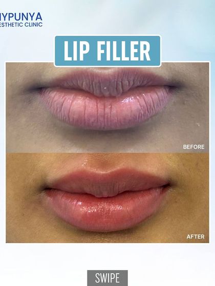 Here is a before and after of a lip filler treatment. Notice the enhanced definition, improved symmetry, and natural-looking volume that creates a beautifully balanced and refreshed appearance.