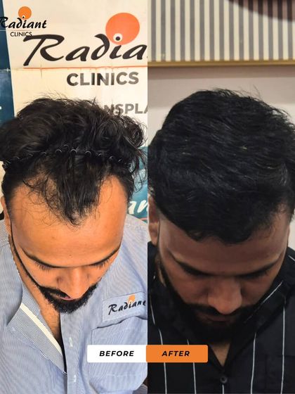 A top-down perspective of the patient in image 28. You can see the significant improvement in density across the entire top of the scalp, eliminating any signs of thinning.