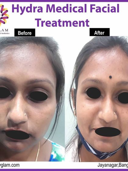 Following a Hydra Medical Facial, this client's skin shows improved clarity and hydration. This non-invasive treatment is excellent for maintaining skin health and achieving a consistent glow.