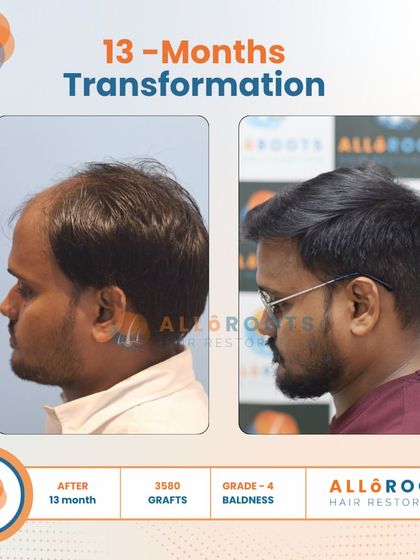 This 13-month transformation of a Grade 4 baldness case was achieved with 3500 grafts. Notice the natural density and the restored hairline from all angles, including a close-up view of the new hair growth.