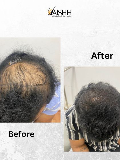 Another view of the crown alopecia treatment, demonstrating the significant fill-in and increased density achieved in 5 months with the FUE-DHT technique.
