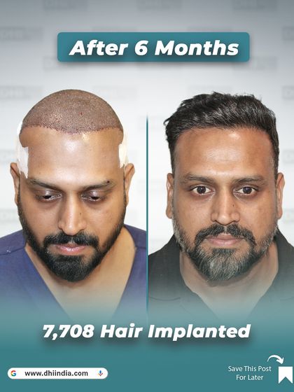 This image captures the immediate post-procedure look compared to the 6-month result. It shows the journey from the day of the transplant to a full, confident head of hair, highlighting the 7,708 hairs implanted by our expert doctors.