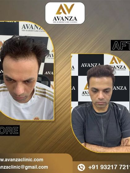 The magic of hair transformation. This client now enjoys a full head of hair, which has completely revitalized his appearance.