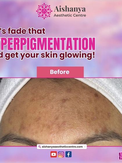 The 'before' image shows significant hyperpigmentation on the forehead. This is a common issue, often caused by sun exposure, and is a perfect candidate for our targeted peel treatments.