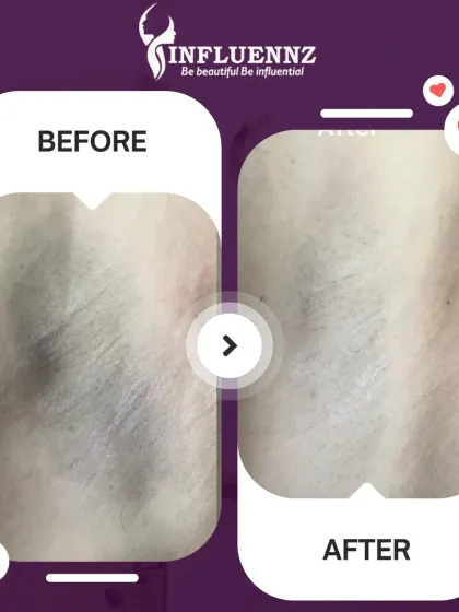 This before and after image shows a significant reduction in underarm pigmentation after a specialized brightening treatment. The skin appears visibly lighter, smoother, and more even-toned, helping restore confidence.