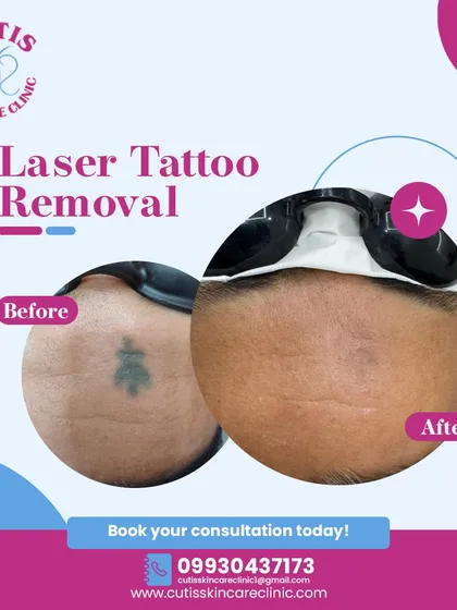 This is a clear example of a successful laser tattoo removal. Using advanced Q-switch laser technology, we were able to significantly fade this tattoo over several sessions, leaving the skin clear and demonstrating the effectiveness of our scar-minimized approach.