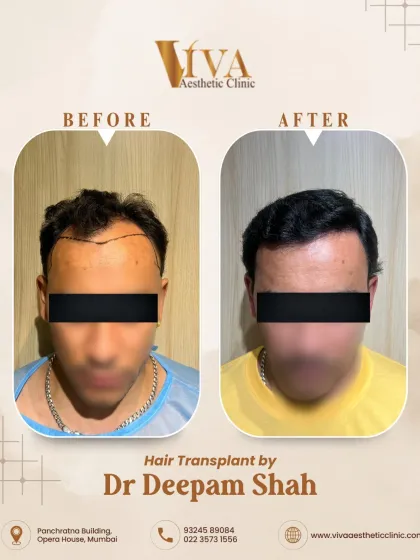 The frontal view shows the significant confidence boost that comes with a well-defined hairline. The best transplant is one that is lived in, not just noticed.
