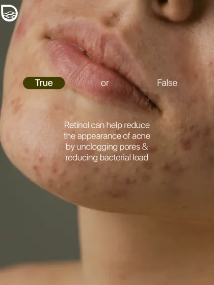 True or False: Retinol can help reduce acne. True. It works by helping to unclog pores and reducing the bacterial load, but it must be used correctly under guidance.