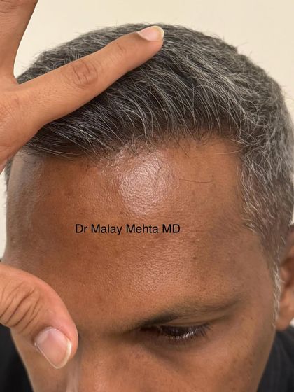 Even with graying hair, the principle remains the same. The hairline is soft, irregular, and looks completely natural. My goal is for people to notice your great hair, not your hair transplant.