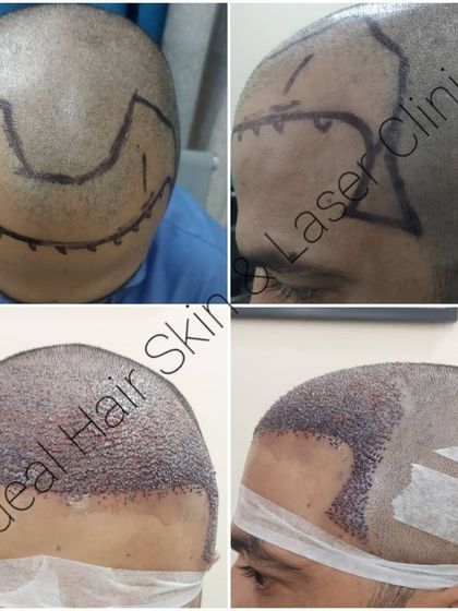 This collage shows the progression from hairline design on a shaved head to the scalp covered with newly implanted grafts, ready for the growth phase to begin.