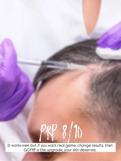 PRP is a highly effective treatment for many of my clients experiencing hair thinning. For those seeking an even more advanced result, I often recommend GFC-PRP, an upgraded formulation that delivers a higher concentration of growth factors.