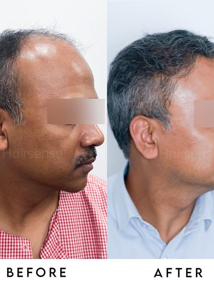 This side view shows the age-appropriate design of the hairline. We avoid creating unnaturally straight or low hairlines for a result that looks distinguished.