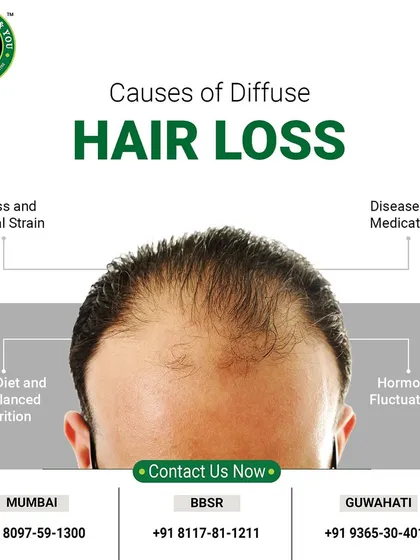 This graphic explains some of the common causes of diffuse hair loss, including stress, poor nutrition, and hormonal fluctuations. Understanding the cause is the first step toward finding the right solution.