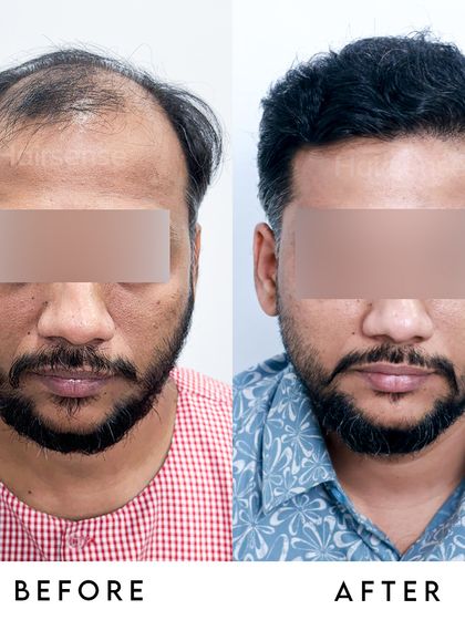 A direct frontal comparison showcasing the dramatic change in our patient's appearance and the confidence that comes with a full head of hair.