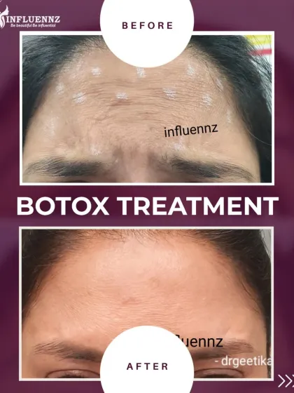 This image shows the treatment markings and the final result of a Botox procedure. Notice how the fine lines on the forehead are visibly softened.