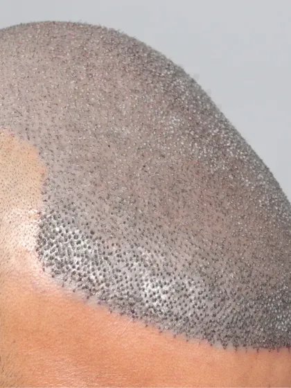 A powerful start for a Norwood Grade 6 case. 6000 grafts were used in a single session for full top coverage.