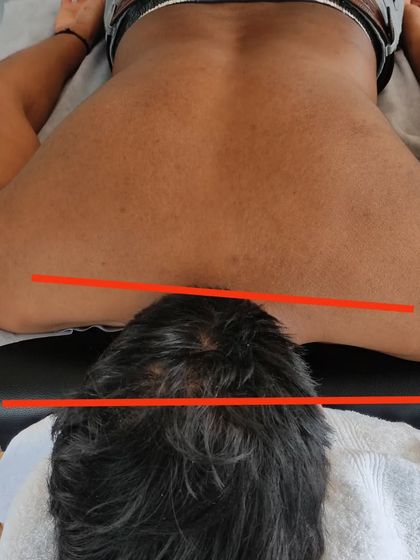 A before shot showing significant shoulder asymmetry and muscle imbalance. This kind of imbalance is a common root cause for pain and injury during lifts.