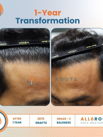 After one year, this patient's Grade 3 baldness was fully addressed with 2670 grafts. The transformation is evident in his smile and the natural, dense hairline that frames his face.