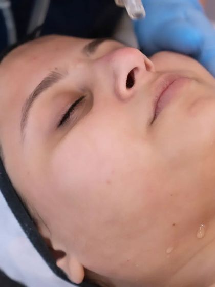 This is the first step of the HydraPro facial, where a special serum is applied to the skin to begin the deep cleansing and hydration process.