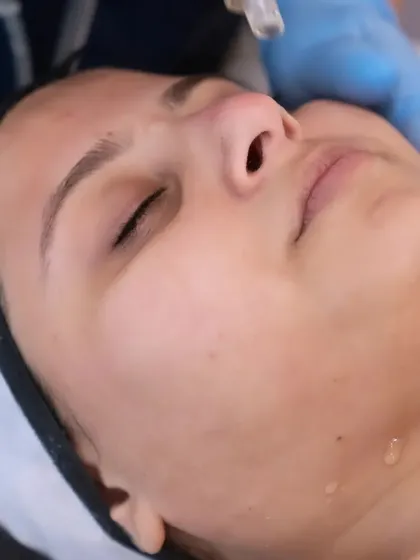 This is the first step of the HydraPro facial, where a special serum is applied to the skin to begin the deep cleansing and hydration process.