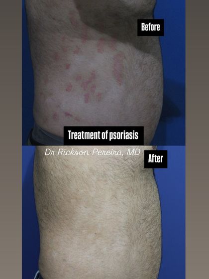 A side profile showing significant improvement in abdominal psoriasis. These results are achieved by using treatments that are scientifically proven to be safe and effective, with minimal need for ongoing blood monitoring.