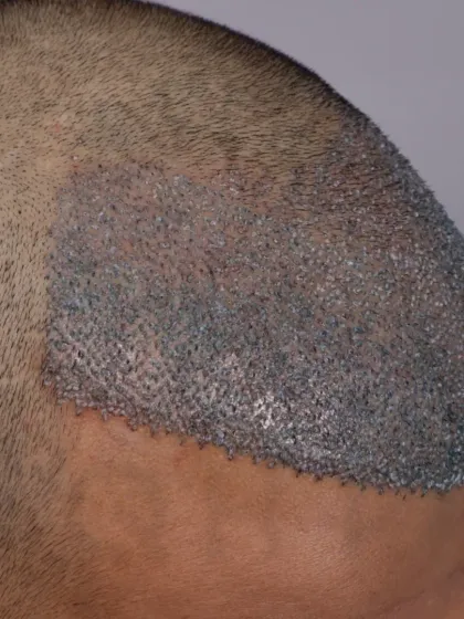 The beginning of a transformation for a Diffuse Grade 4a patient. 3400 grafts were placed to recreate the hairline and restore the frontal and mid-scalp.