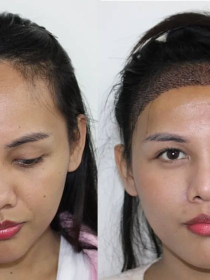 This image clearly shows the 'before' state and the 'post-surgery' state, where the new hairline has been created by implanting thousands of grafts.