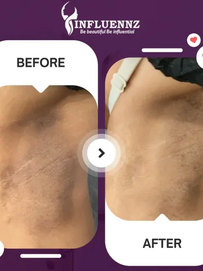 This before and after shot highlights the transformation possible with targeted underarm treatments. The pigmentation and unevenness are visibly reduced, restoring the skin's natural tone.