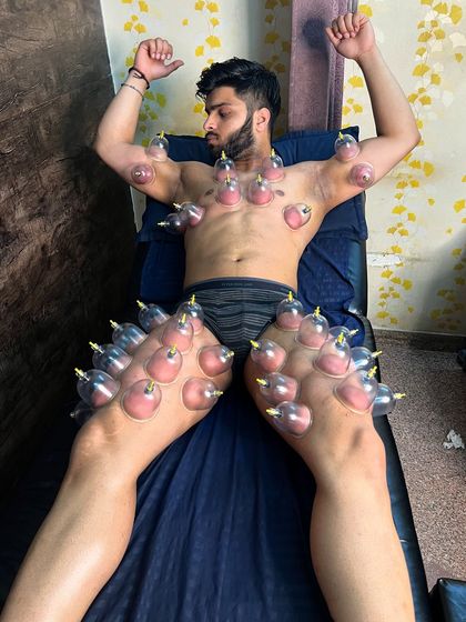 A full-body dry cupping session in progress. This treatment is highly effective for athletes looking to enhance recovery and improve muscle function.