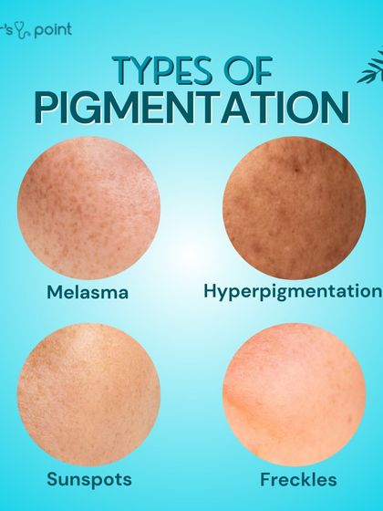 Understanding your pigmentation is the first step to treating it. This guide shows the different types we treat, including melasma, hyperpigmentation, sunspots, and freckles.