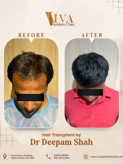 The top view of the same patient shows how even a smaller number of grafts can make a huge impact when placed strategically by an experienced surgeon.