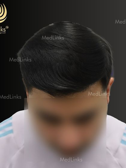 The top-down view after the transplant, demonstrating the excellent coverage.