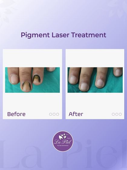 Pigmentation can also affect the nails, causing discoloration that can be concerning. This before-and-after shows the successful outcome of our pigment laser treatment on a nail, restoring its natural and healthy appearance.