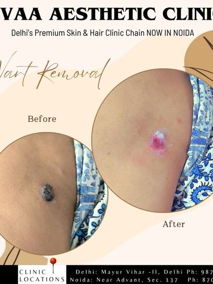 A before-and-after of a wart removal treatment, showcasing the clean and smooth result achieved with our advanced, painless technology.