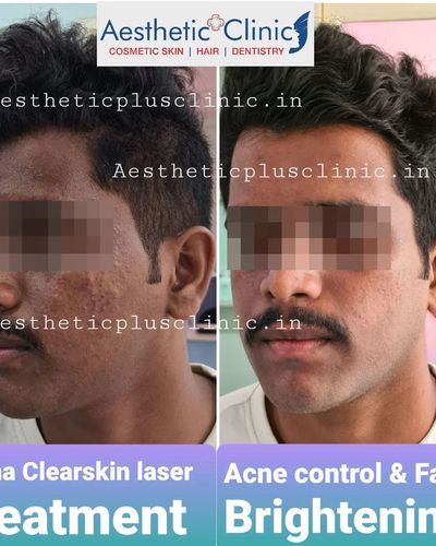 Corrective Skin Treatments