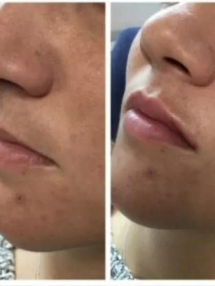 This before-and-after demonstrates a subtle yet impactful lip enhancement using dermal fillers. The goal was to add volume and definition for a fuller, more youthful smile.