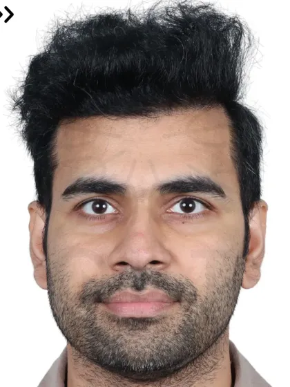 A 14-month transformation for a Diffuse Grade 5A case. We used 4200 grafts to recreate the hairline and re-densify the frontal and mid-scalp.