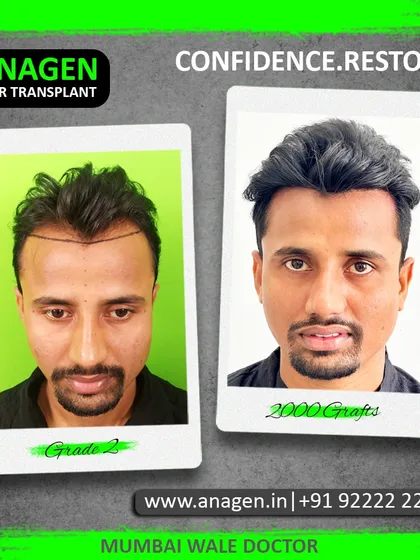 "Confidence. Restored." This patient's Grade 2 hair loss was corrected with 2000 grafts, giving him a sharp, defined hairline and a major confidence boost.