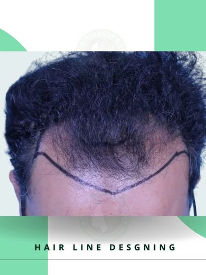 This image shows another example of a custom hairline design. The shape is carefully planned to match the client's facial structure and create the most natural-looking result possible.