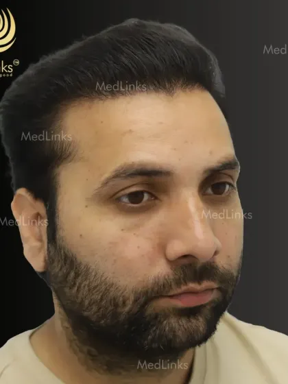 The 'after' shot shows a strong, natural hairline and excellent density. The hair can be styled in any way, just like natural hair.