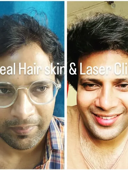 A side-by-side comparison illustrating the effectiveness of our hair restoration treatment. The patient's hair appears significantly thicker and healthier in the after photo.