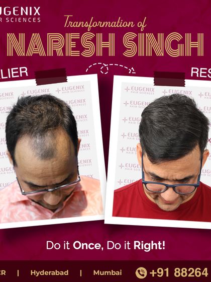 The complete transformation of Naresh Singh, showcasing a restored hairline and renewed look.