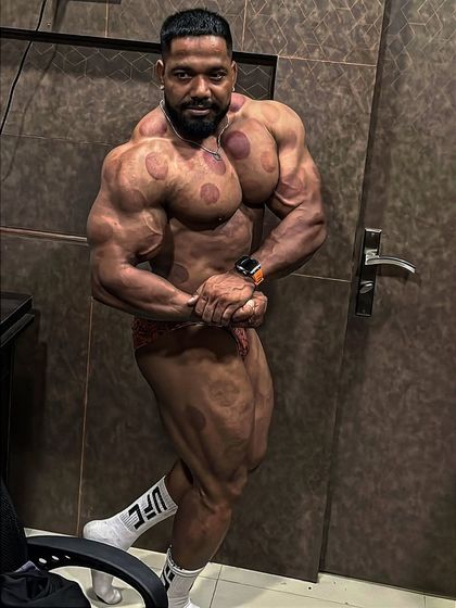 The marks of recovery. Cupping is an ancient technique that I use to relieve muscle soreness and improve performance.